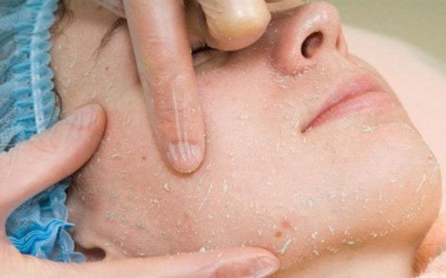 ochistka-lichi…po-gollivudski