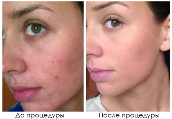 Когда пора заняться RF-лифтингом тела