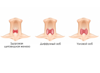 Зоб щитовидной железы: факторы риска, признаки и методы диагностики.