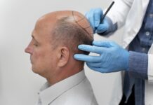 Пересадка волос для мужчин: что нужно знать перед принятием решения