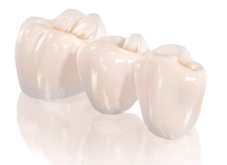 Протезирование циркониевыми коронками: надежность и эстетика нового уровня